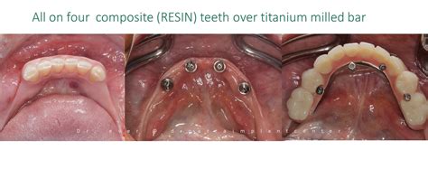 Trouble with first implant 